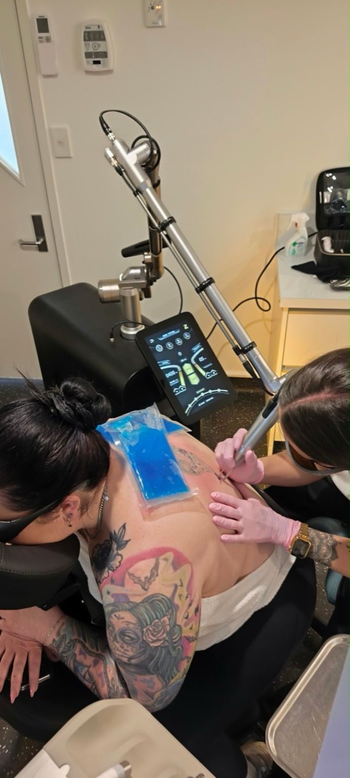 A back tattoo being treated at The Laser Co., with a cooling pack on the skin and the Zenith Excelsior handpiece in use.